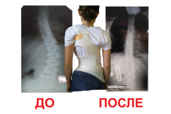 Корсет Шено