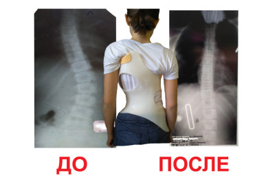 Корсет Шено